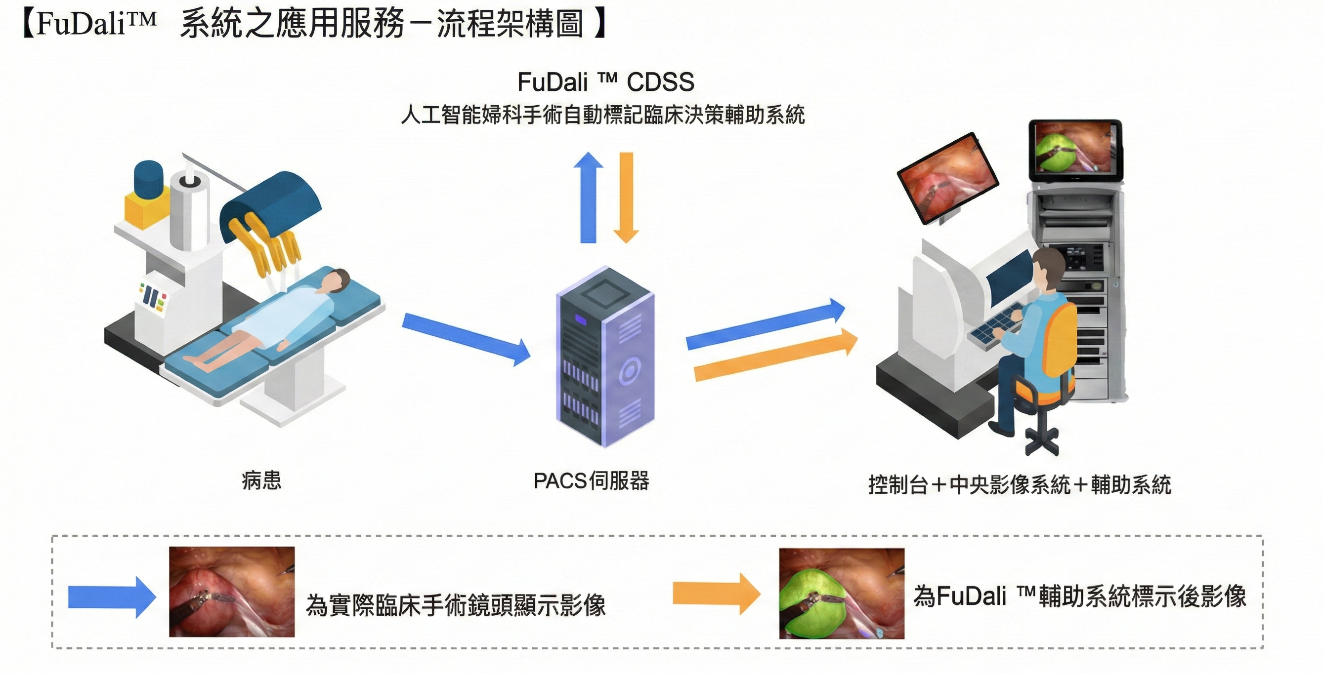 The research team plans to integrate the AI-powered gynecological surgery automatic annotation clinical decision support system into the PACS server used in da Vinci surgeries. Through dual screens or split-screen displays, real-time surgical images and AI-based organ annotations can be shown simultaneously, enhancing diagnostic efficiency and accuracy.