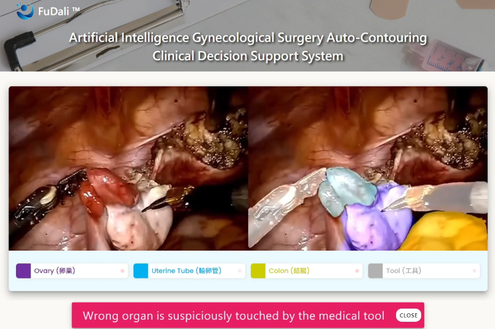 The system can also be integrated into surgical platforms to provide real-time identification of key tissues, with alerts triggered when surgical instruments approach critical organs.