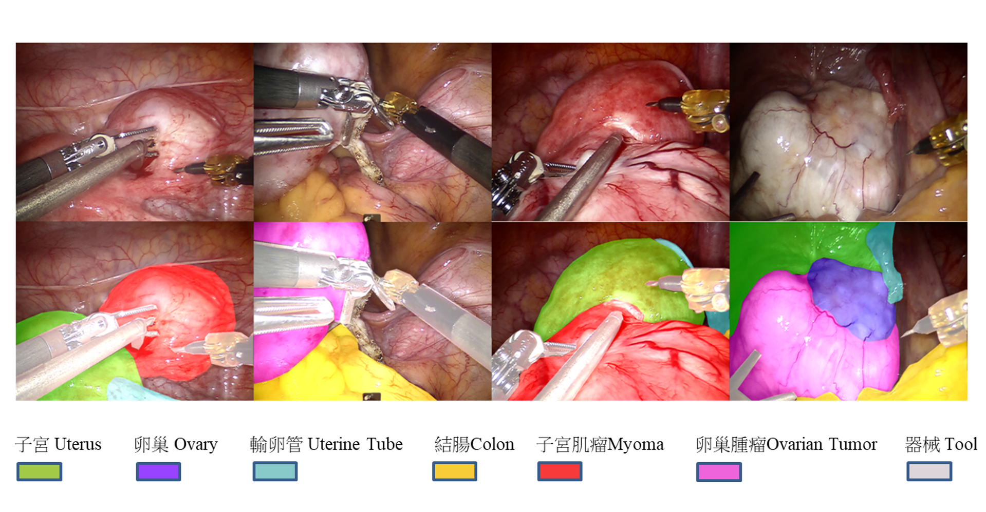 The team’s self-developed “Organ Image Segmentation System (DeepVinci)” performs real-time recognition during surgery and clearly marks tissues such as the uterus, ovaries, fallopian tubes, colon, and tumors with color overlays, helping surgeons identify boundaries and reduce the risk of accidental injury.